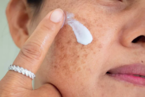Os 7 Melhores Clareadores de Melasma em 2026!