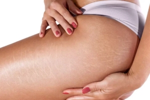 7 Melhores Cremes para Estrias em 2026 Palmers, Bio-Oil, Cicatrissim e mais.